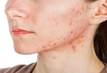 acne on the face